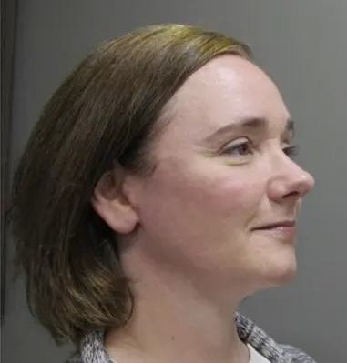 john-s-lee-beaverton-plastic-surgery-facelift-case-18-right-side-Thumbnail