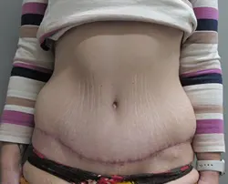 nw-portland-plastic-surgery-in-beaverton-tummy-tuck-case-20-featured