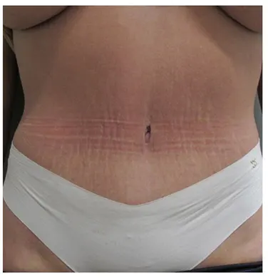 nw-portland-plastic-surgery-in-beaverton-tummy-tuck-case-21-front-thumb