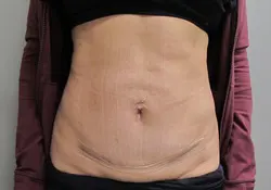 nw-portland-plastic-surgery-in-beaverton-tummy-tuck-case-22-featured