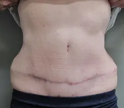 nw-portland-plastic-surgery-in-beaverton-tummy-tuck-case-23-featured