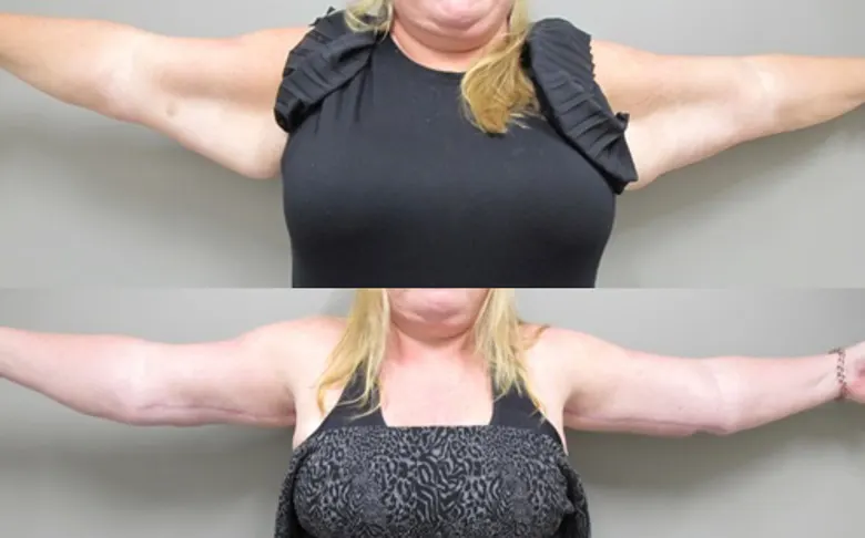 Dr-Lee-Portland-Plastic-Surgery-in-Beaverton-OR-case-13-brachioplasty-front-2