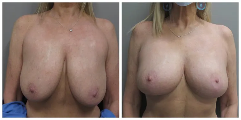 Dr-Lee-Portland-Plastic-Surgery-in-Beaverton-OR-case7-breast-lift-after-front