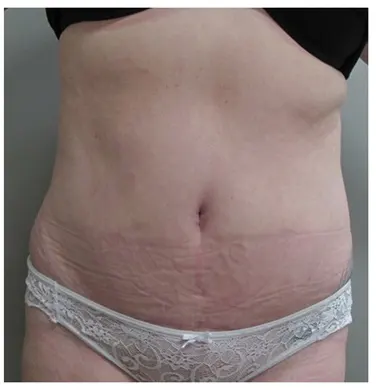 nw-portland-plastic-surgery-in-beaverton-tummy-tuck-case-24-front-thumb