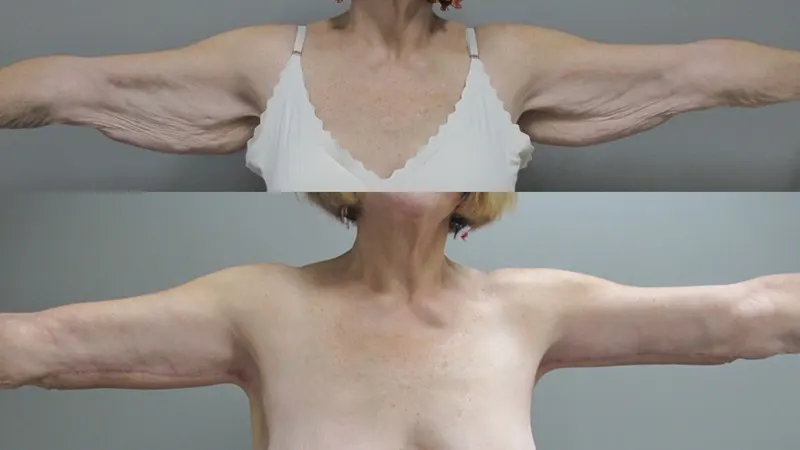 Dr-Lee-Portland-Plastic-Surgery-in-Beaverton-OR-case-6-brachioplasty-front