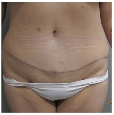 John S Lee MD Plastic Surgery Abdominoplasty Case 26 front thumb