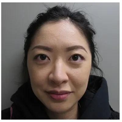 John S Lee MD Plastic Surgery Blepharoplasty Case 18 front-thumb