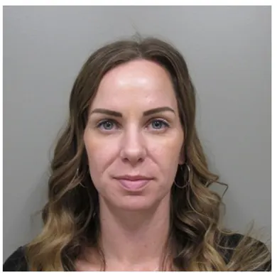 John S Lee MD Plastic Surgery Blepharoplasty Case 20 - After front thumb