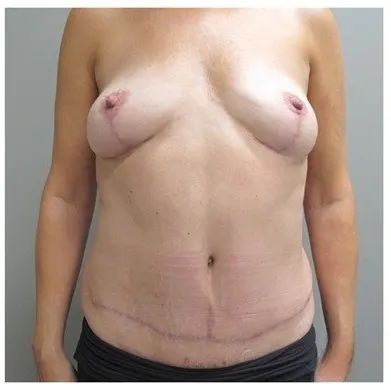 John S Lee MD Plastic Surgery Mommy Makeover Case 16 - after front thumb