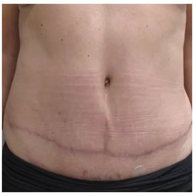 John S Lee MD Plastic Surgery Tummy Tuck Case 27 - front thumb