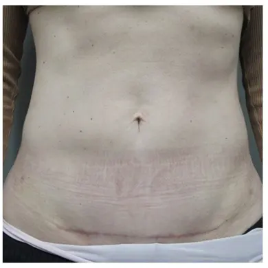 John S Lee MD Plastic Surgery Tummy Tuck Case 28 front - Thumb
