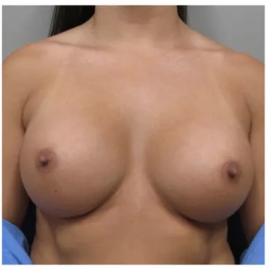 John S Lee MD Plastic Surgery Breast Augmentation Case 36 - Front thumb