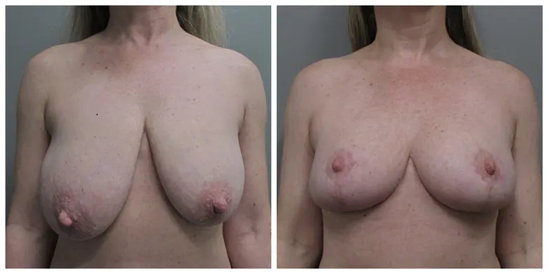 John S Lee MD Plastic Surgery Breast Lift Case No 9 - front