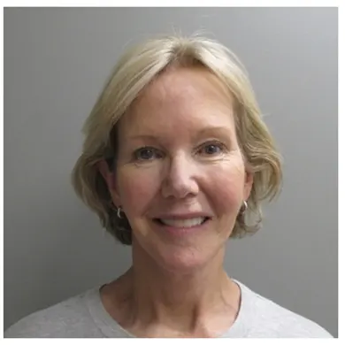 John S Lee MD Plastic Surgery Facelift Case 30 - Front thumb