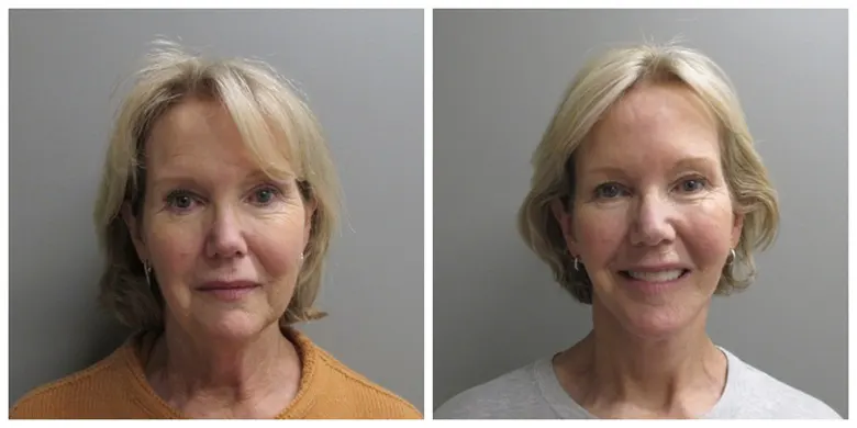 John S Lee MD Plastic Surgery Facelift Case 30 - Front