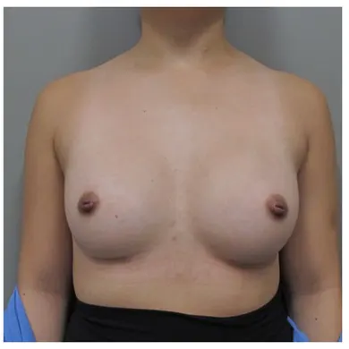 John S Lee MD Plastic Surgery Breast Augmentation Case 37 - front thumb