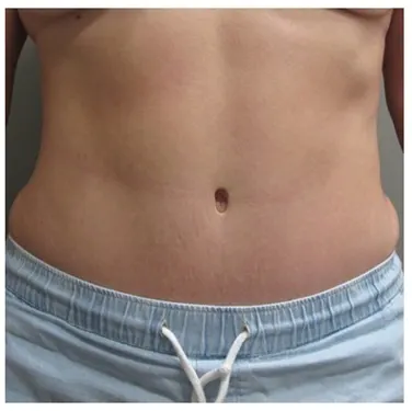 John S Lee MD Plastic Surgery abdominoplasty case 29 - front thumb