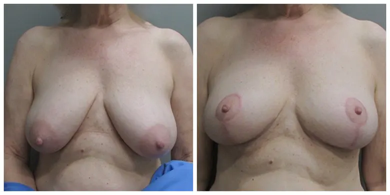 John S Lee MD Plastic Surgery breast lift case no 10 front