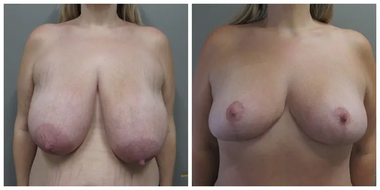 John S Lee MD Plastic Surgery Breast Reduction Case 21 Front