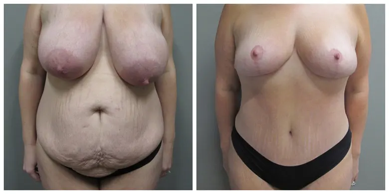 John S Lee MD Plastic Surgery Mommy Makeover Case 30 - front-1
