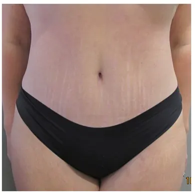 John S Lee MD Plastic Surgery Mommy Makeover Case 30 - front-2-thumb