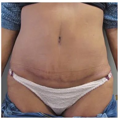 Dr. John S. Lee plastic surgery tummy tuck case 31 front-thumb