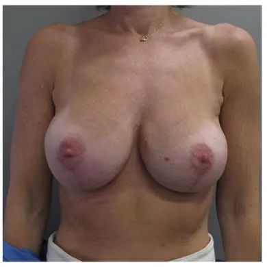 John S Lee MD Plastic Surgery Breast Implant Exchange with Lift Case 38 - front thumb