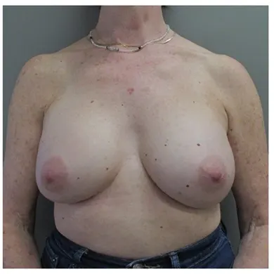 John S Lee MD Plastic Surgery BBA Case 38 - Front-Thumb
