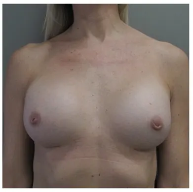 John S Lee MD Plastic Surgery BBA Case 39 - Front-Thumb