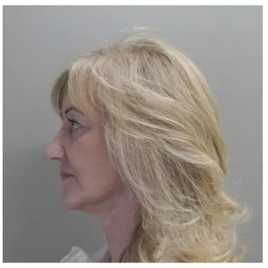 John S Lee MD Plastic Surgery Facelift Case Study 37 - LP-thumb