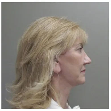 John S Lee MD Plastic Surgery Facelift Case Study 37 - RP-thumb