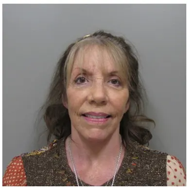 John S Lee MD Plastic Surgery Facelift Case Study 38 front-thumb