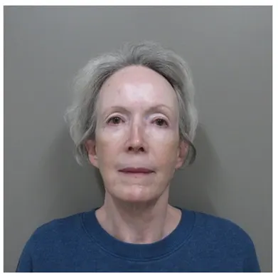 John S Lee MD Plastic Surgery facelift case study 36 front-thumb