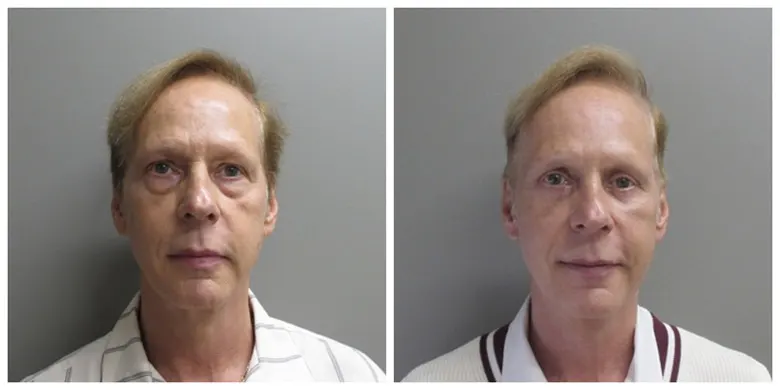 John S Lee MD Plastic Surgery Blepharoplasty Case 32-front