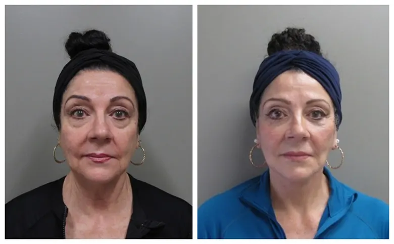 John S Lee MD Plastic Surgery blepharoplasty case 34 - front