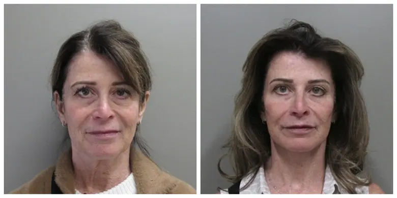 John S Lee MD Plastic Surgery facelift case 42 - front